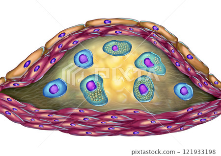 Structure of atherosclerotic plaque 121933198