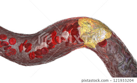 Atherosclerosis, atheromatous plaque inside artery Atherosclerosis, atheromatous plaque inside artery 121933204