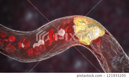 Atherosclerosis, atheromatous plaque inside artery Atherosclerosis, atheromatous plaque inside artery 121933205
