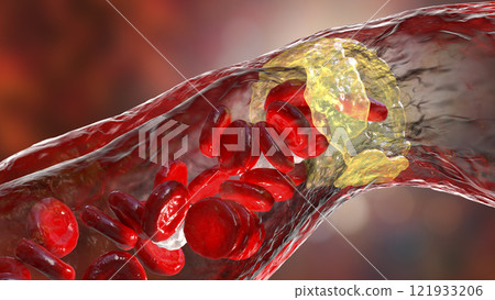 Atherosclerosis, atheromatous plaque inside artery Atherosclerosis, atheromatous plaque inside artery 121933206