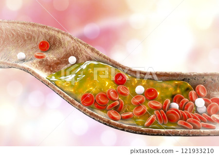 Cholesterol plaque in artery 121933210