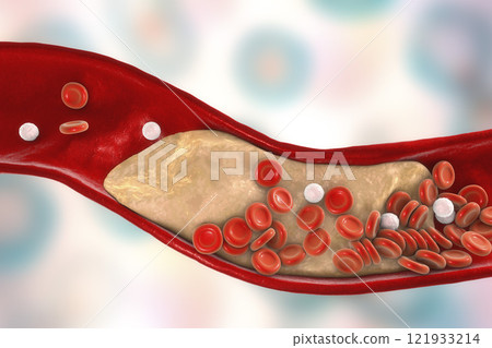 Cholesterol plaque in artery 121933214