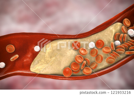 Cholesterol plaque in artery Cholesterol plaque in artery 121933216