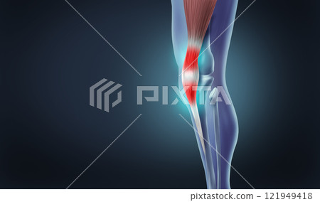 Tendonitis Knee Pain 121949418