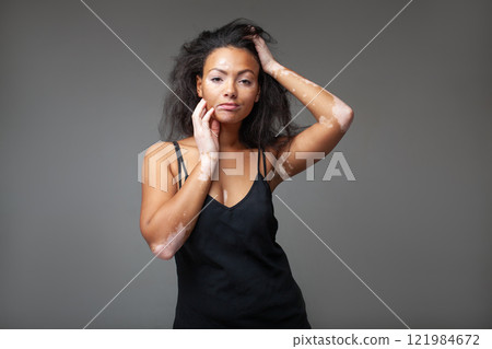 Confident fashion model with vitiligo with hand in Confident fashion model with vitiligo with hand in 121984672