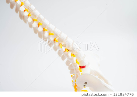 Spinal nerve and bone, Lumbar spine displaced herniated disc fragment, Model for treatment medical in the orthopedic department. 121984776