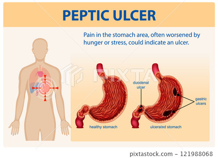 Understanding Peptic Ulcers and Stomach Pain 121988068