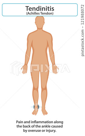 Achilles Tendonitis Illustration and Symptoms 121988072