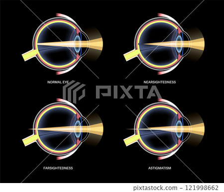 Refractive errors poster 121998662