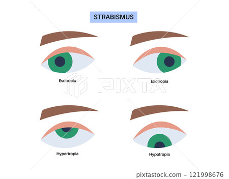 Strabismus eye disease 121998676
