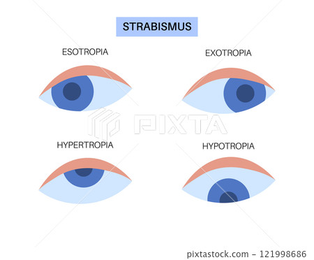 Strabismus eye disease Strabismus eye disease 121998686