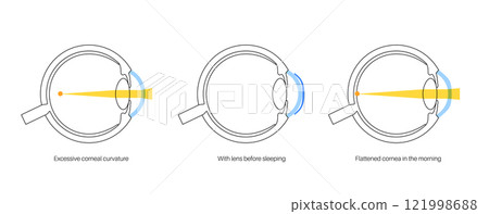 Orthokeratology contact lens 121998688