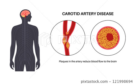 Carotid artery disease 121998694