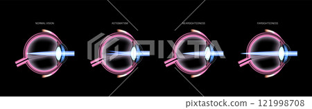Refractive errors poster Refractive errors poster 121998708