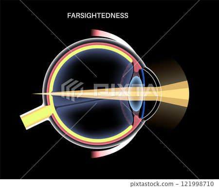 Farsightedness eye disease 121998710