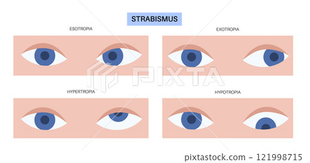 Strabismus eye disease Strabismus eye disease 121998715