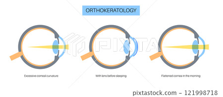 Orthokeratology contact lens 121998718
