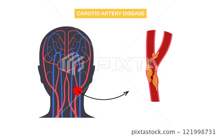 Carotid artery disease 121998731