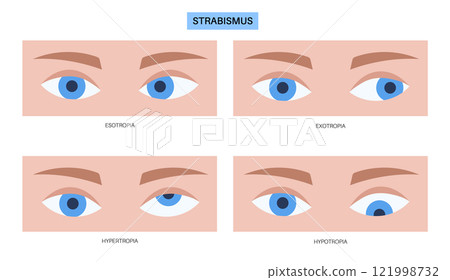 Strabismus eye disease Strabismus eye disease 121998732