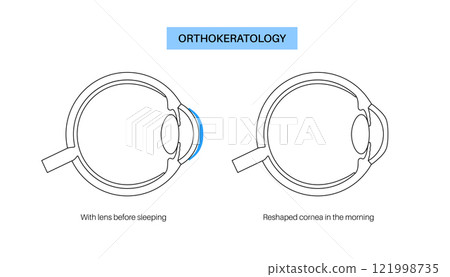 Orthokeratology contact lens 121998735