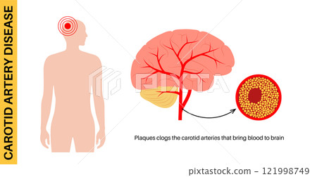 Carotid artery disease 121998749