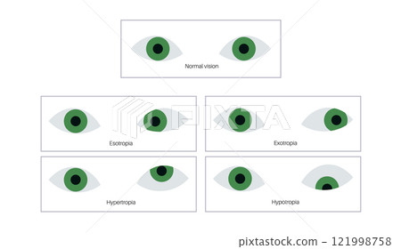Strabismus eye disease 121998758