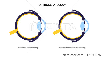 Orthokeratology contact lens 121998760