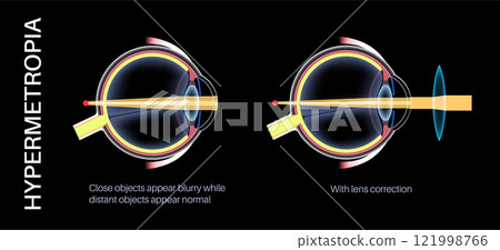 Farsightedness lens correction 121998766