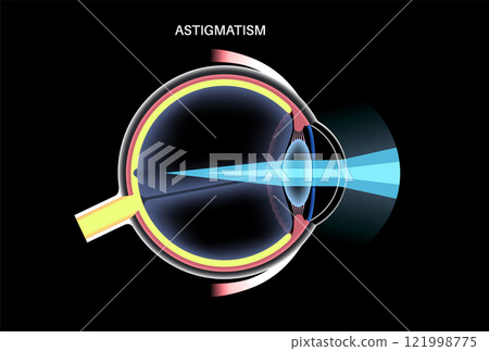 Astigmatism eye disease 121998775