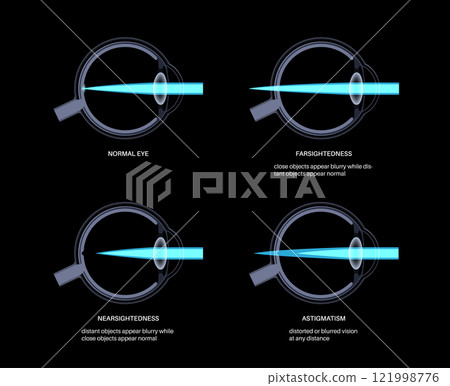 Refractive errors poster 121998776
