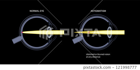 Astigmatism eye disease Astigmatism eye disease 121998777
