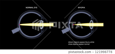 Normal eye and nearsightedness Normal eye and nearsightedness 121998778