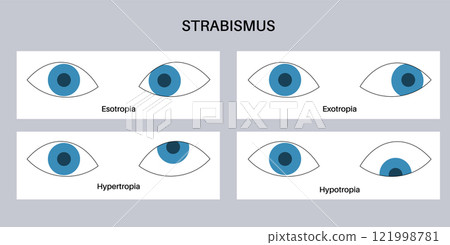 Strabismus eye disease Strabismus eye disease 121998781
