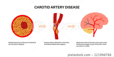 Carotid artery disease Carotid artery disease 121998788