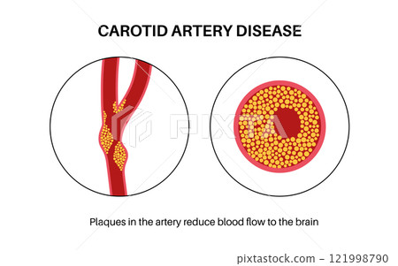 Carotid artery disease 121998790