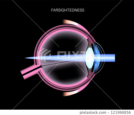Farsightedness eye disease 121998856