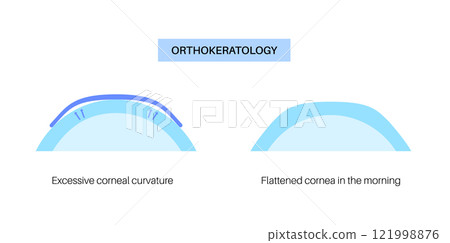 Orthokeratology contact lens Orthokeratology contact lens 121998876