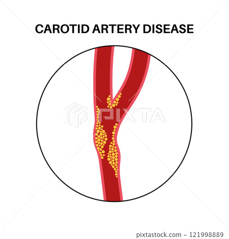Carotid artery disease 121998889