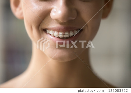 Cropped closeup teenage female wear orthodontic brackets for correcting bite 122003822