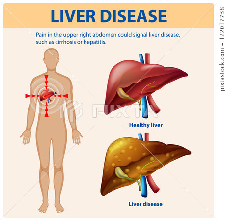 Understanding Liver Disease and Symptoms Understanding Liver Disease and Symptoms 122017738