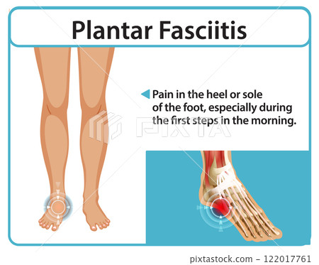Understanding Plantar Fasciitis Pain Relief 122017761