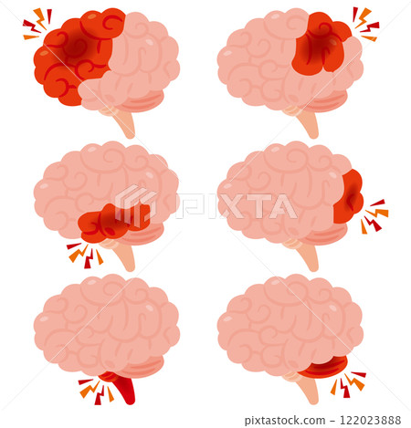 腦出血大腦的插圖，側視圖 122023888