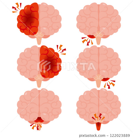 腦出血大腦插圖，前視圖 122023889