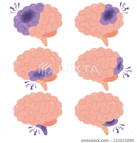 Illustration of a brain with cerebral infarction (side view) 122023890