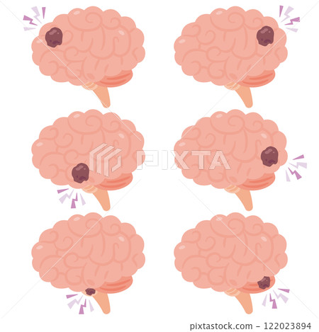 大腦有腫瘤的插圖,側面視圖 大腦有腫瘤的插圖,側面視圖 122023894