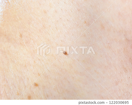 脖子根部的疣 122030695