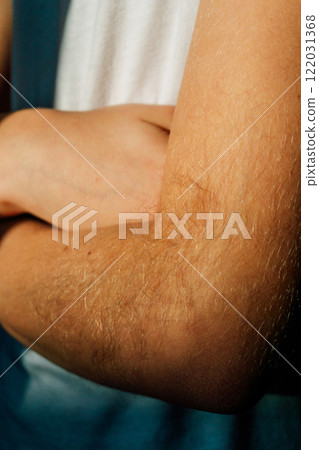 the student has very hairy hands. the problem with the abundant growth of hair in the child's arms the student has very hairy hands. the problem with the abundant growth of hair in the child's arms 122031368