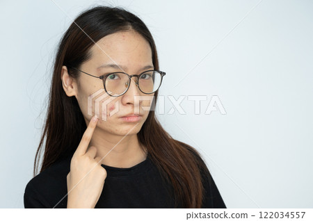 Young Asian woman pointing to acne problems on her face. Inflamed acne consists of swelling, redness, and pores that are deeply clogged with bacteria, oil, and dead skin cells. 122034557