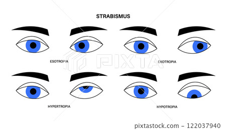 Strabismus eye disease 122037940