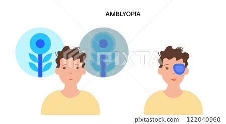 Amblyopia or lazy eye 122040960